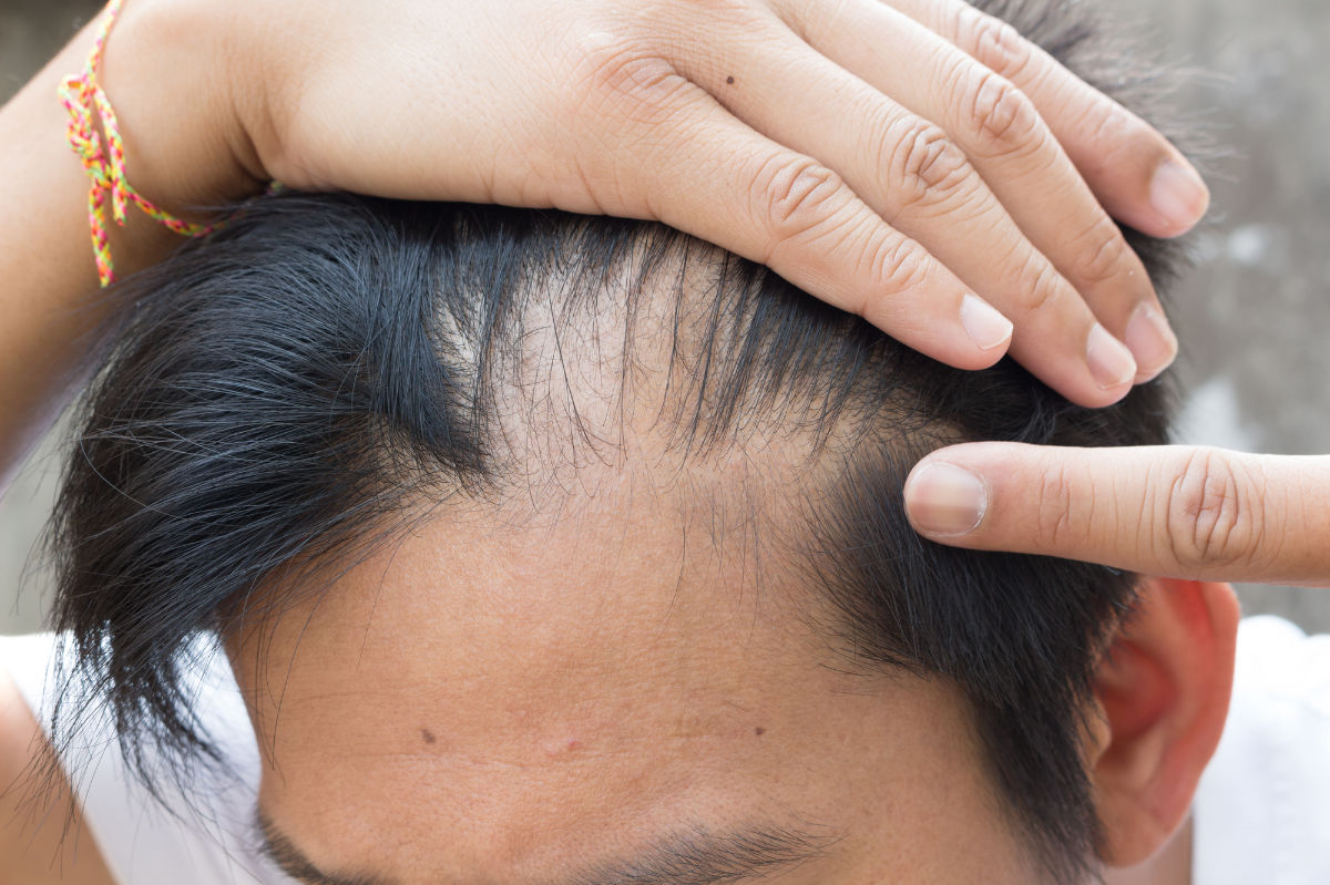 What Is Male Pattern Baldness And Can It Be Treated Hair Skin Science