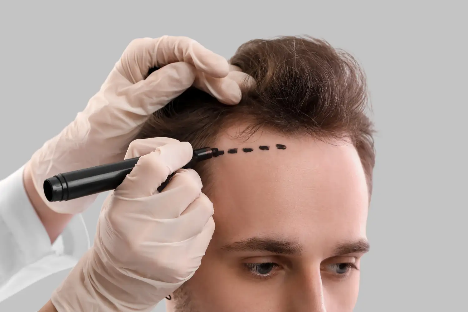 Is a Hair Transplant Right for You? Assessing Candidacy & Expectations -  Hair & Skin Science