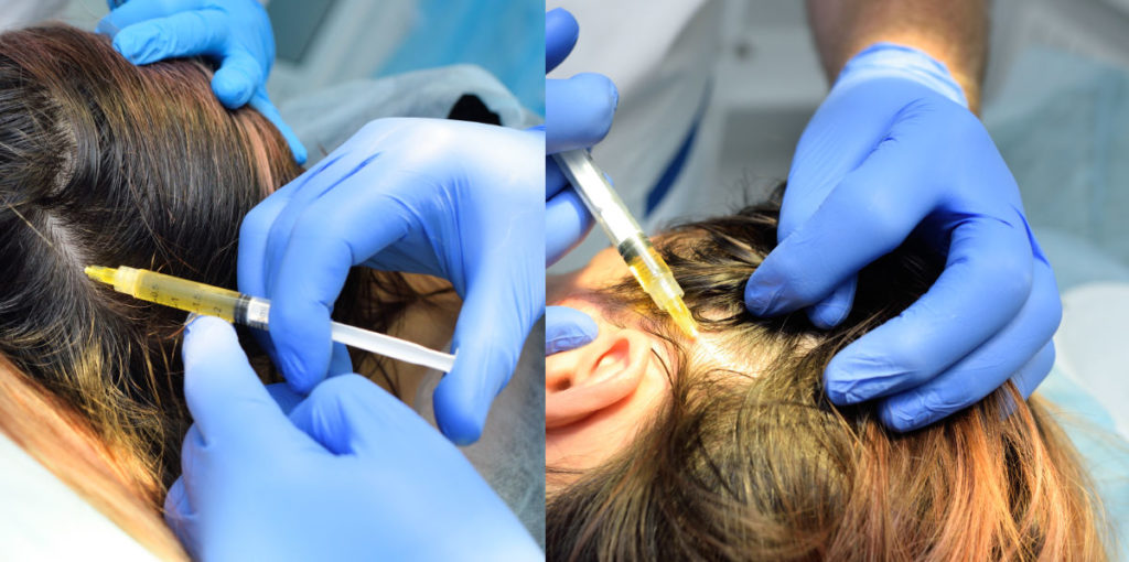PRP Hair Injections