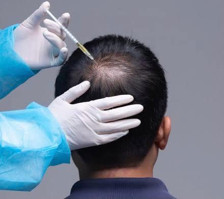 Male PRP Hair loss treatment injection