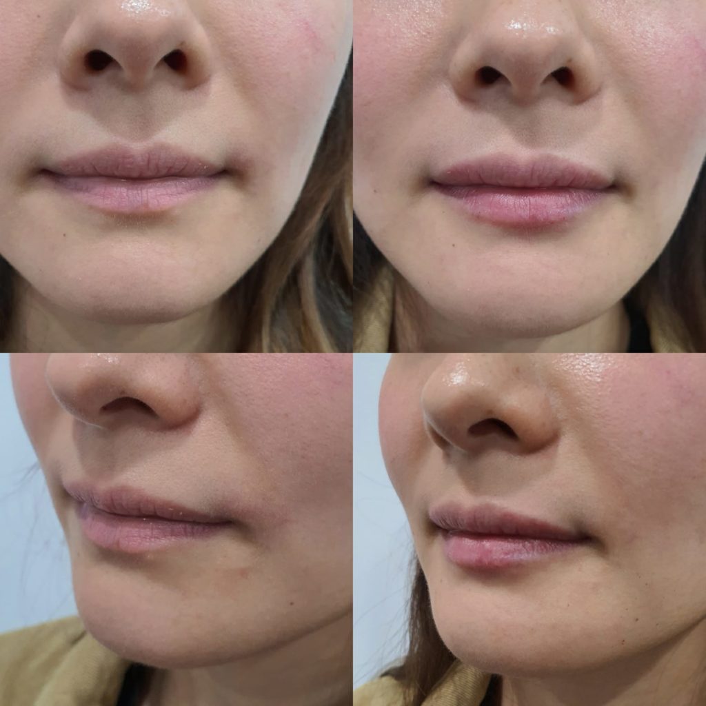 Lip filler before and after photo
