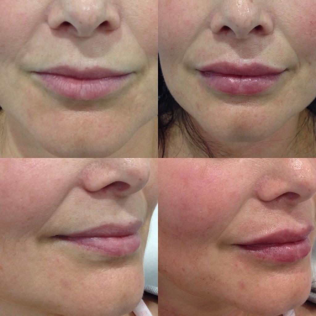 Dermal Fillers Melbourne &amp; Sydney Cosmetic &amp; Face Fillers