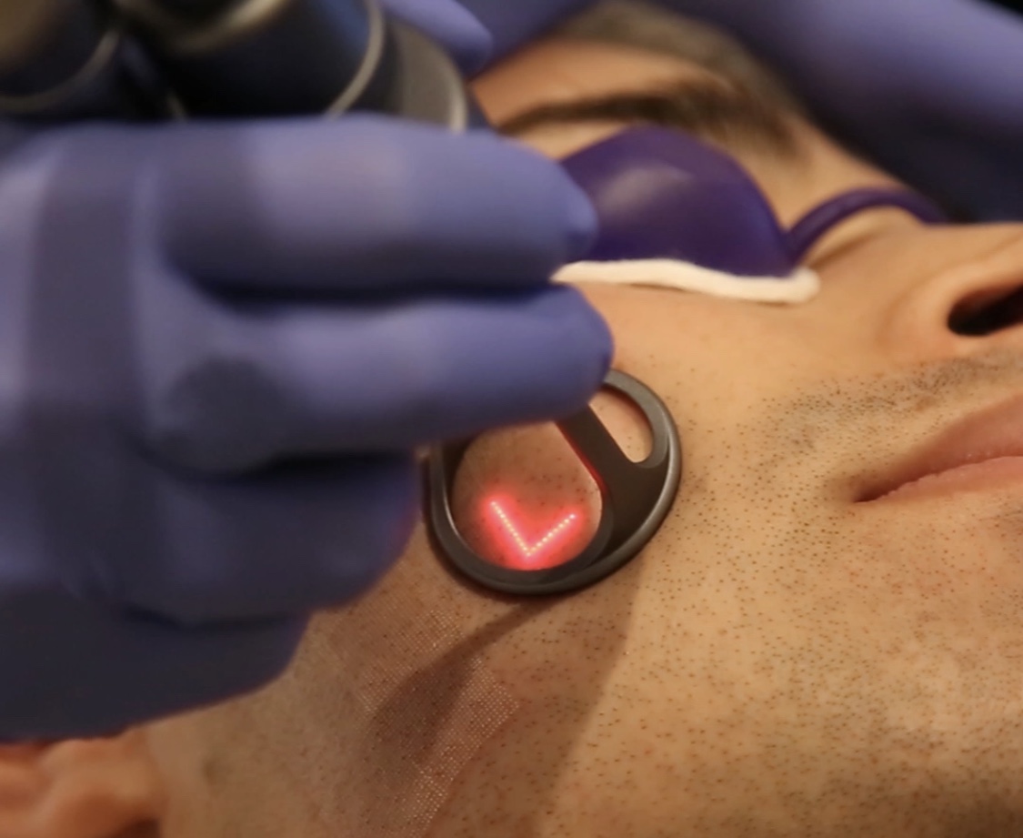 Co2 Fractional Laser Treatment | Sydney, Melbourne, Brisbane