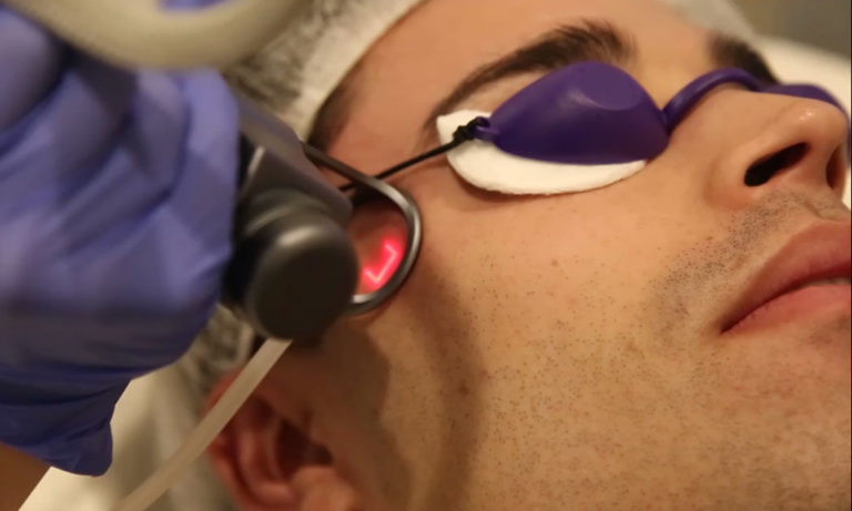 Home 6 Laser-Skin-Resurfacing
