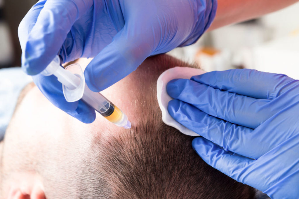 Factor 4 for Hair loss & Skin Rejuvenation 2 Male prp hair treatment injection