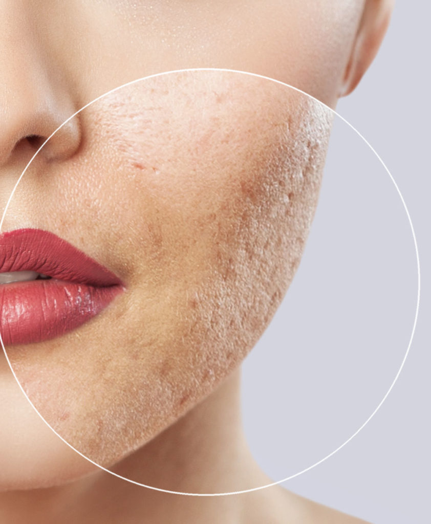 PRP for Acne Scars 1 Acne Scarring Woman