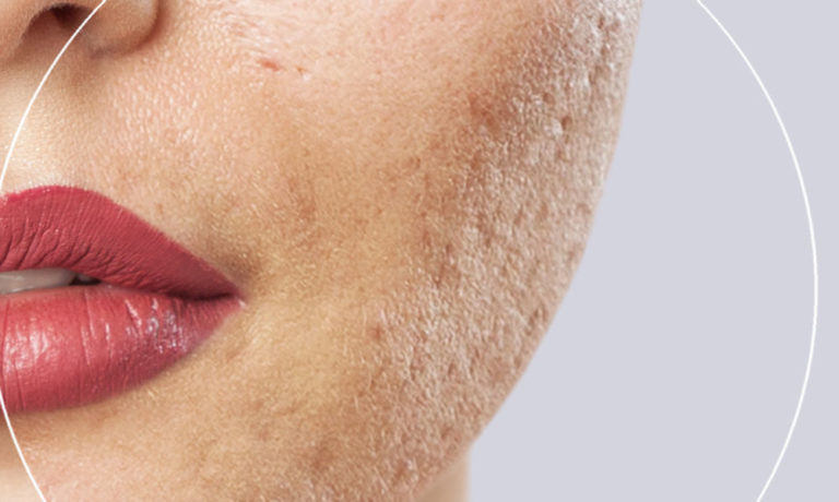 Home 14 Acne Scarring Wide
