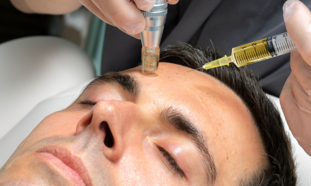Micro-Needling Treatment 1 Middle aged man having micro needle cosmetic treatment.