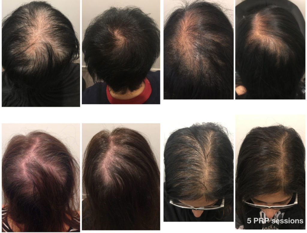Female PRP Hair Before & Afters