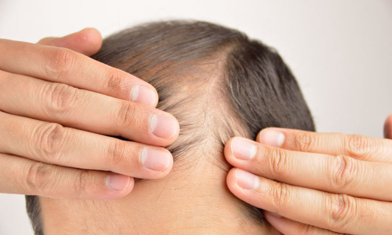 Home 12 man controls hair loss with white background