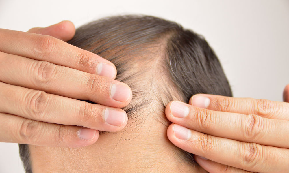 Male suffering from hair loss and thinning