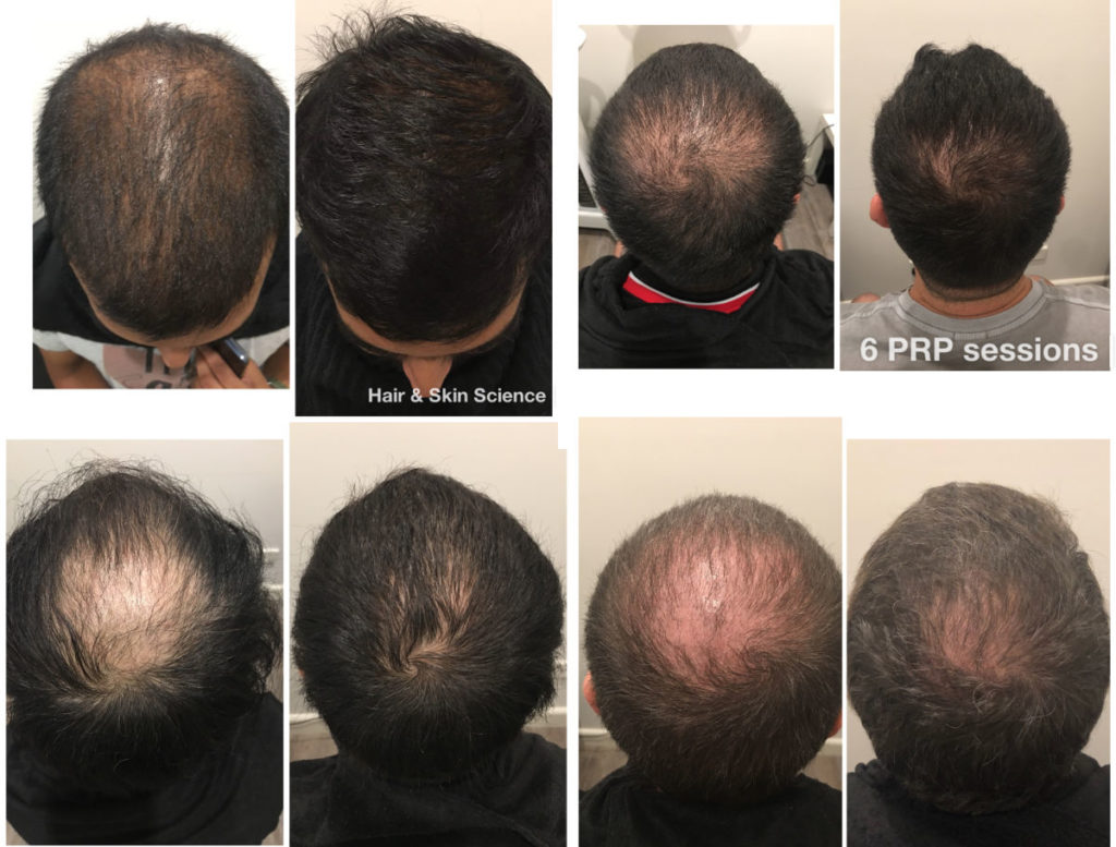Male PRP Hair Before & Afters
