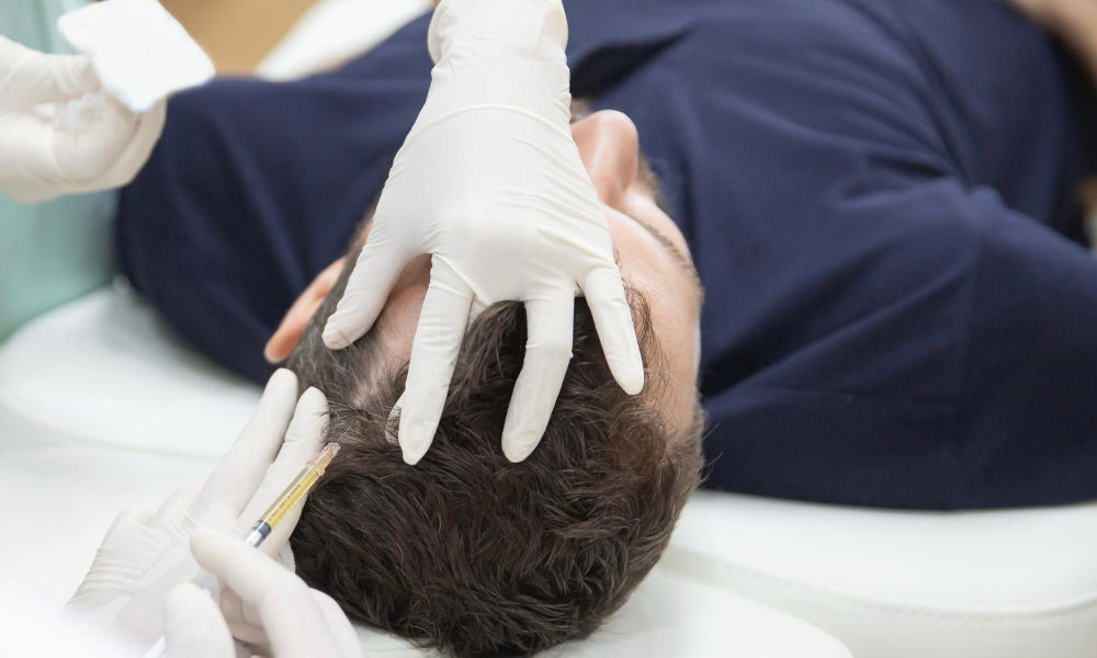 PRP Hair Loss Treatment Brisbane 1 Male PRP hair loss treatment injection