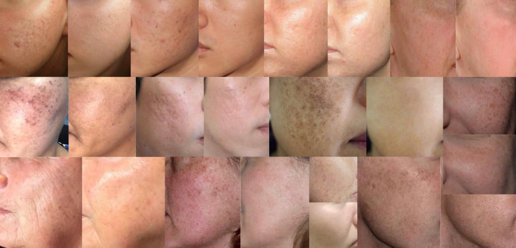 PRP Skin Before and Afters Collage