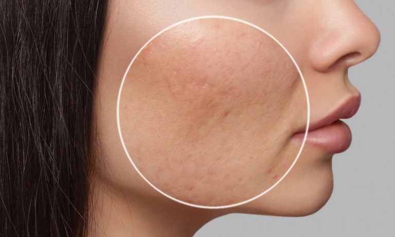 Woman with Acne Scarring