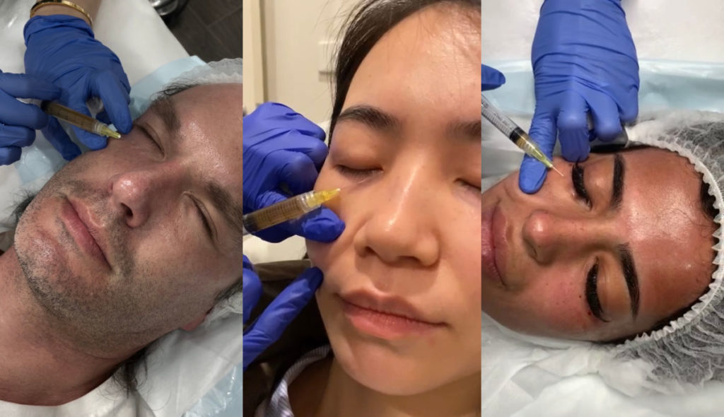 Multiple photos of PRP injections for dark circles under eyes