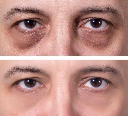 Male Dark Cicles Under Eye Before & After