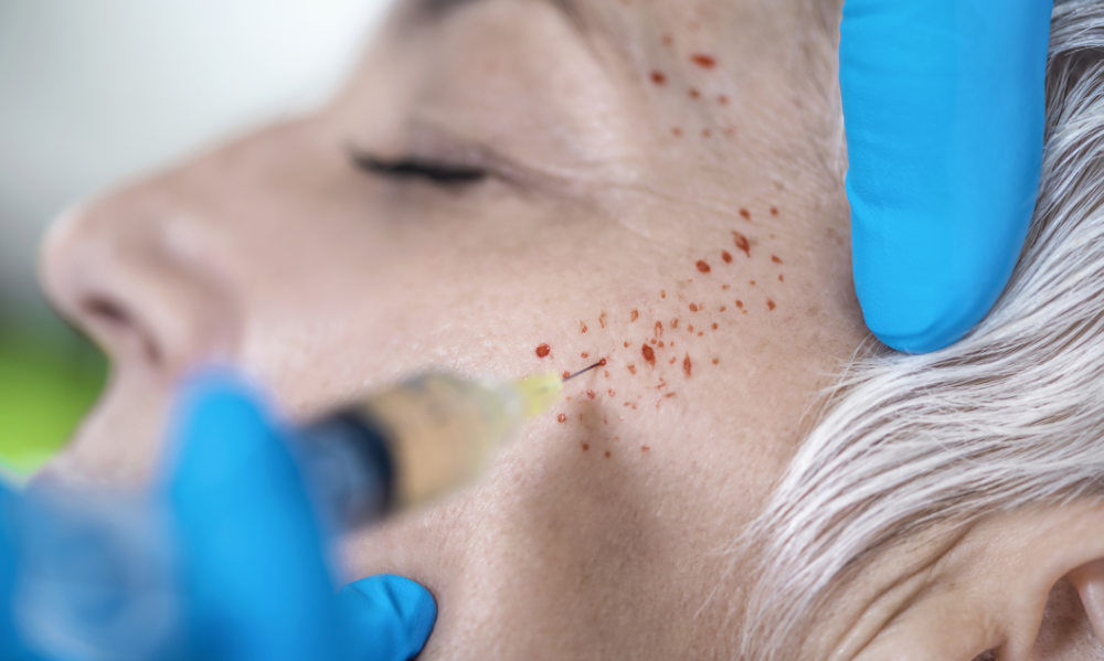 Vampire Facial Brisbane 1 PRP Vampire Facial Injection