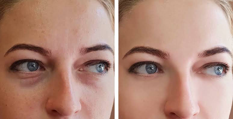 Before & After of woman after dark circles under eyes treatment