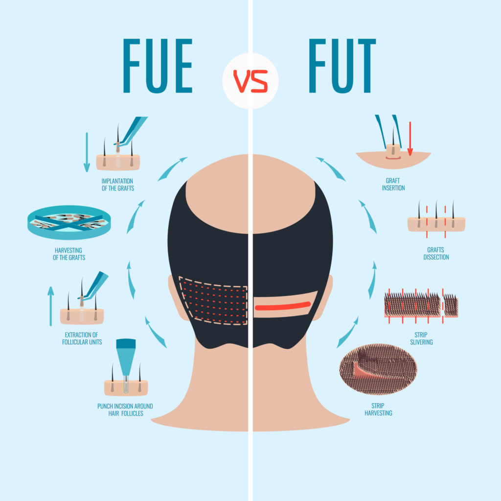 FUE vs FUT Hair Transplants
