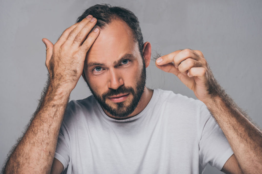What Is Male Pattern Baldness and Can It Be Treated? 1
