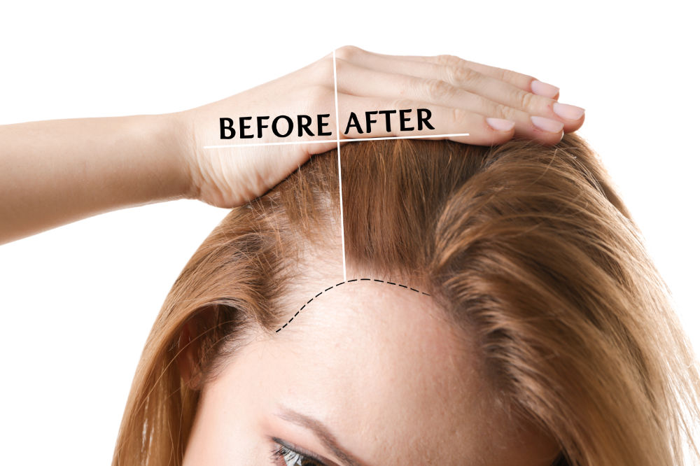 Female Pattern Baldness Before & After