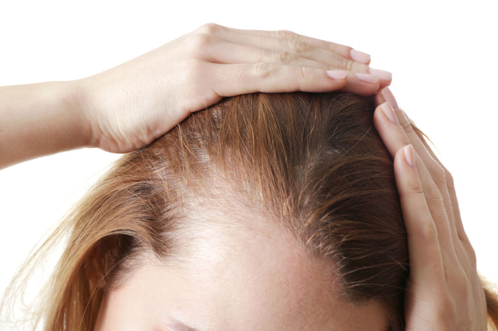What Is Female Pattern Baldness and Can It Be Treated? Hair & Skin