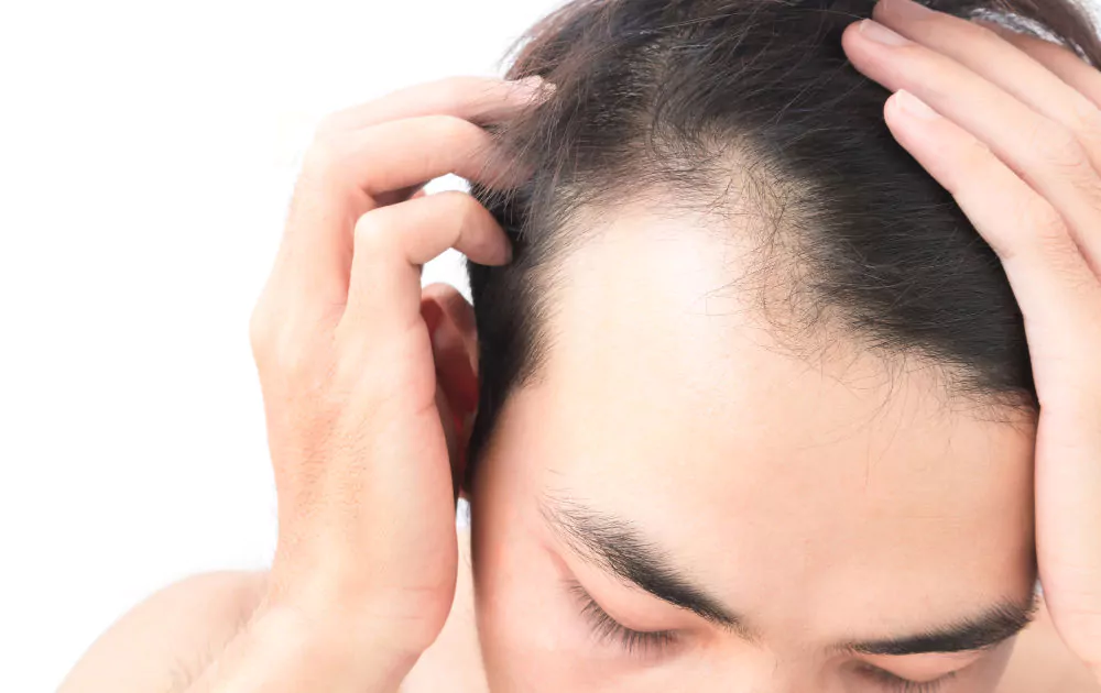 Receding Hairline: Stages, Causes, Prevention & Treatments