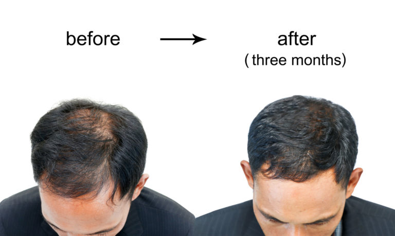 Best Hair Loss Treatments for Men