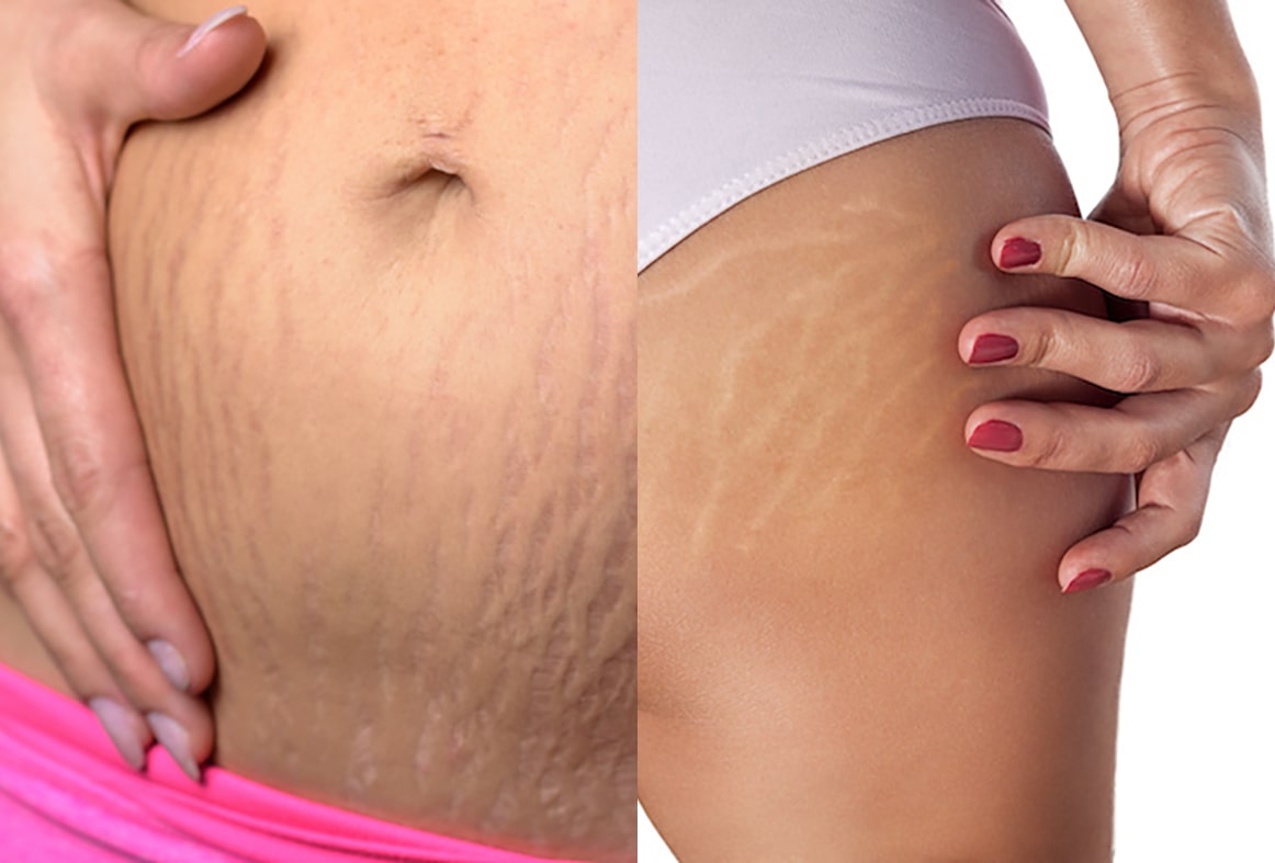 PRP for Stretch Marks 1