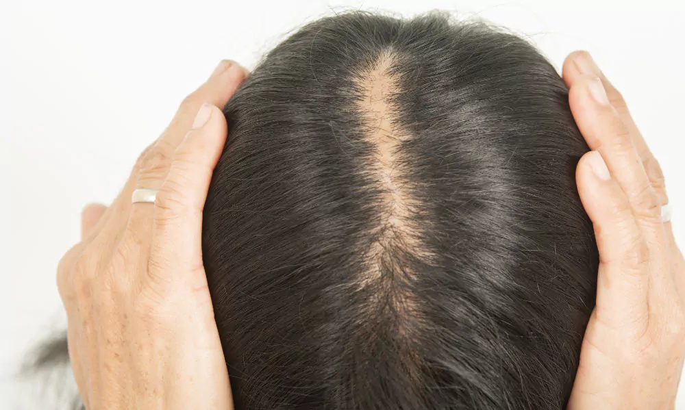 Female Hair Loss & Thinning Hair Women | Hair & Skin Science