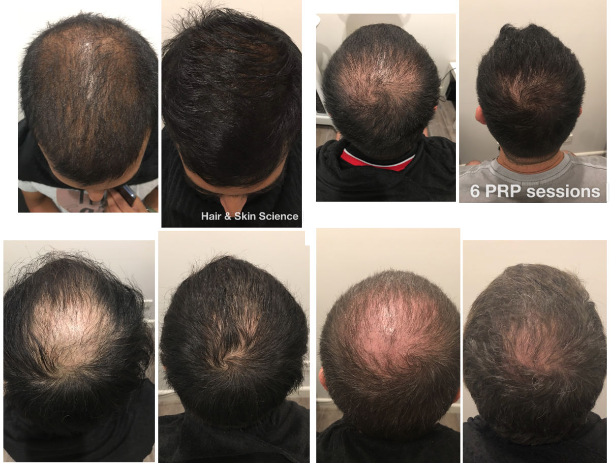 PRF Hair Loss Treatment | Sydney, Melbourne, Brisbane, Perth & Gold Coast