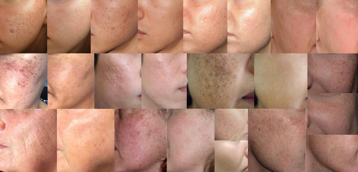 PRP-Skin-Before-Afters-Collage