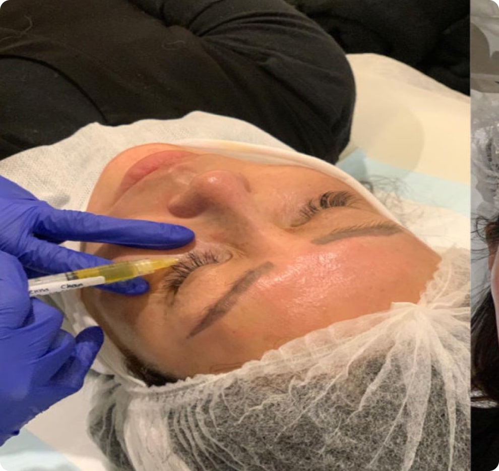 PRP Facials: Everything You Need To Know 7 PRP Facial procedure
