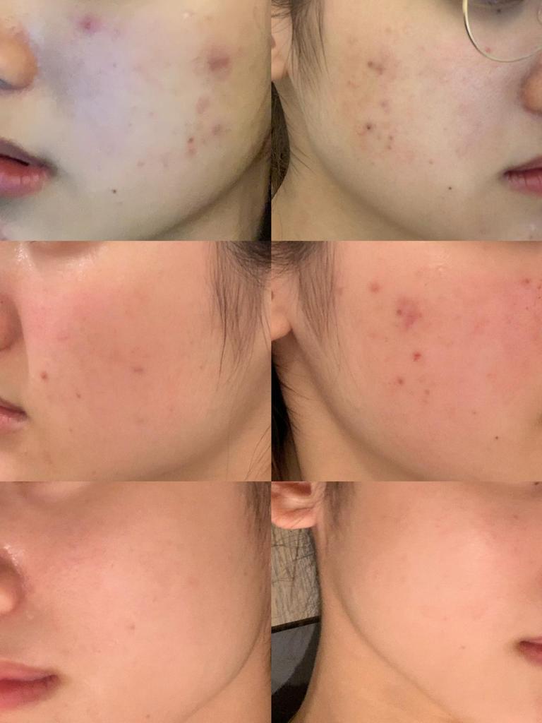 PRP before and after – See the results for yourself 2