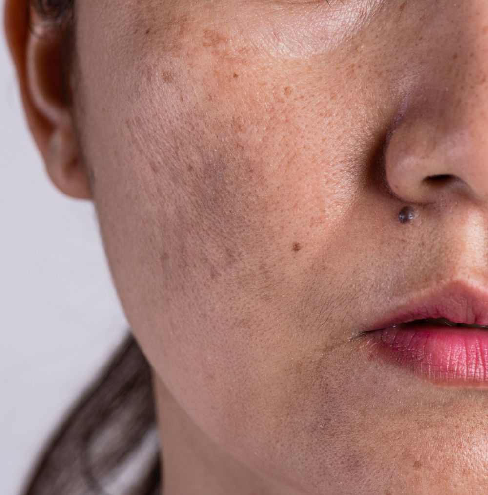 Effective Pigmentation Treatments 8 Effective Pigmentation Treatments 7