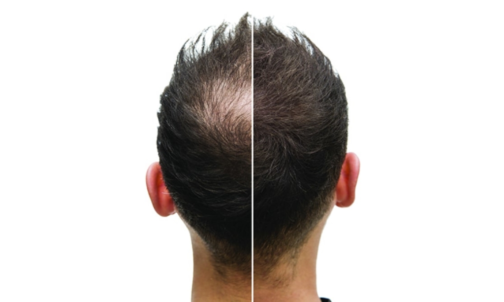 How long does it take to see results from PRP hair treatment? 9
