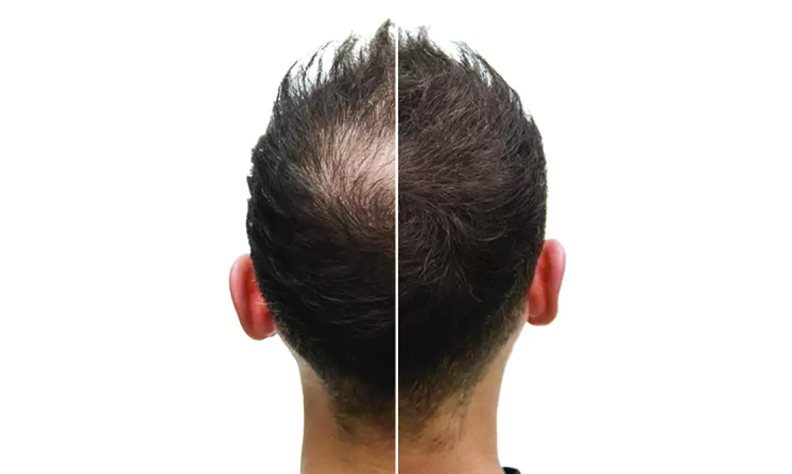 How Long to See Results From PRP Hair Treatment | Hair & Skin Science
