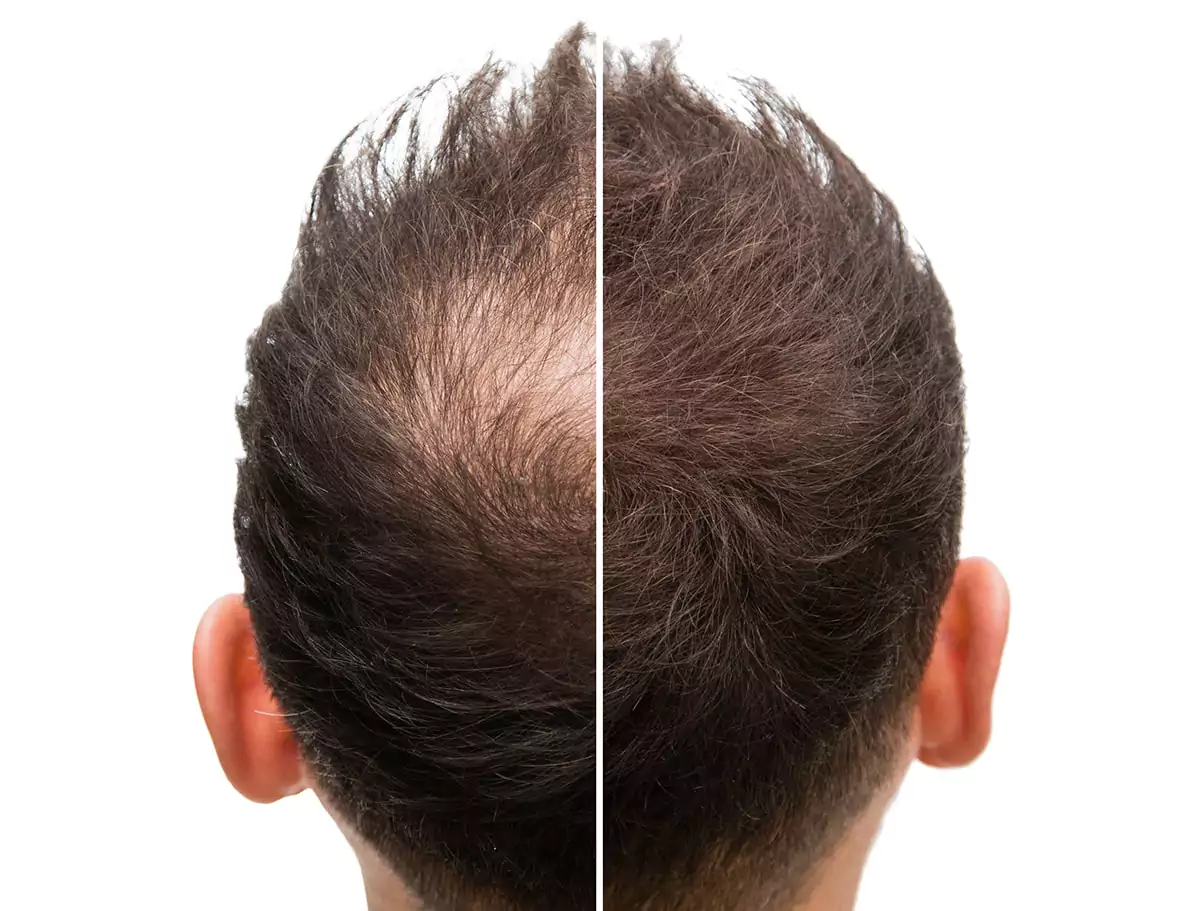 hair-regrowth-ba-example-male-min