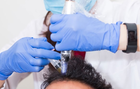 PRP Hair loss treatment