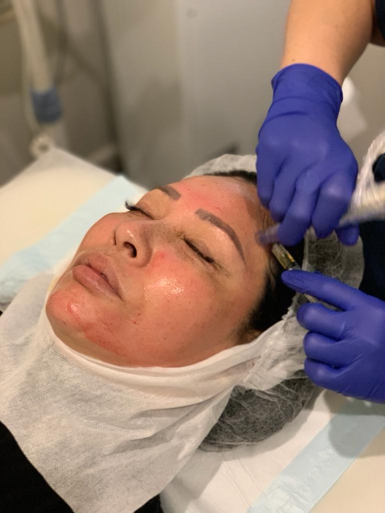 What is PRP skin treatment? 2