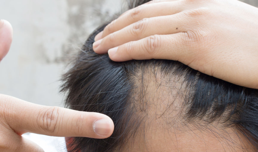 What is Alopecia? 3