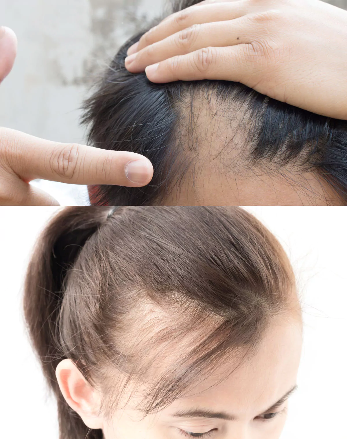 Alopecia Causes, Symptoms, Types and Treatment Options