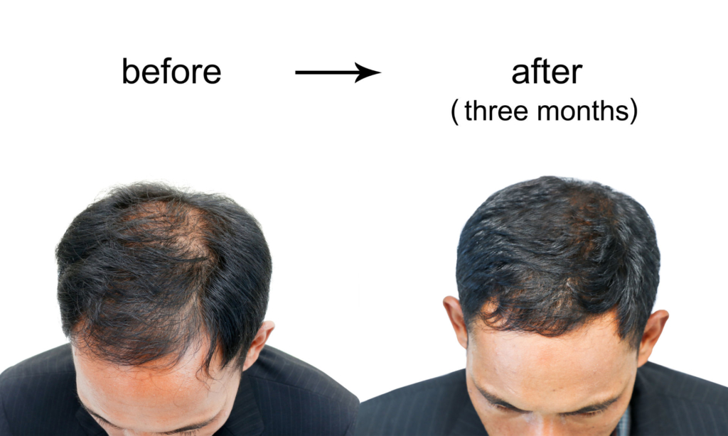 Best Hair Loss Treatments for Men 2