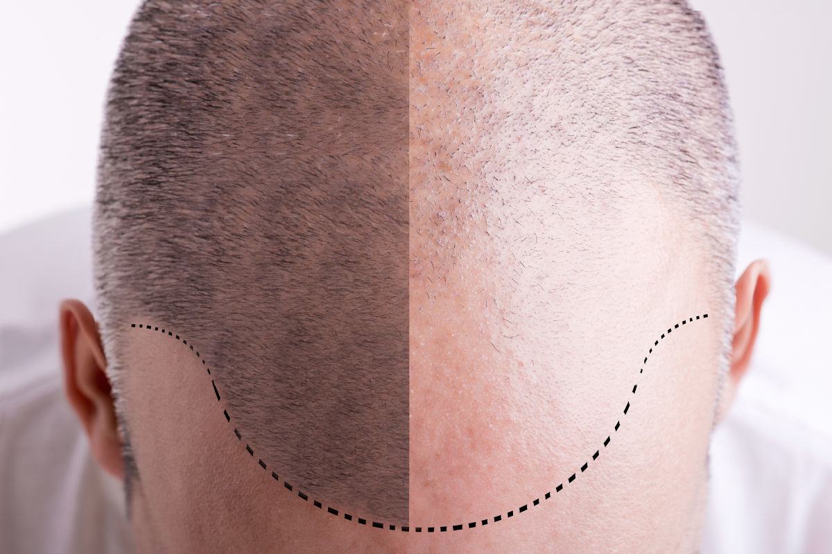 What Is Male Pattern Baldness and Can It Be Treated? 3