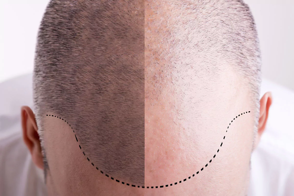Best Hair Loss Treatments for Men 2