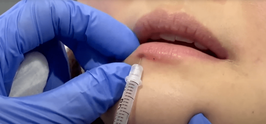 The Best Lip Filler Treatments 5