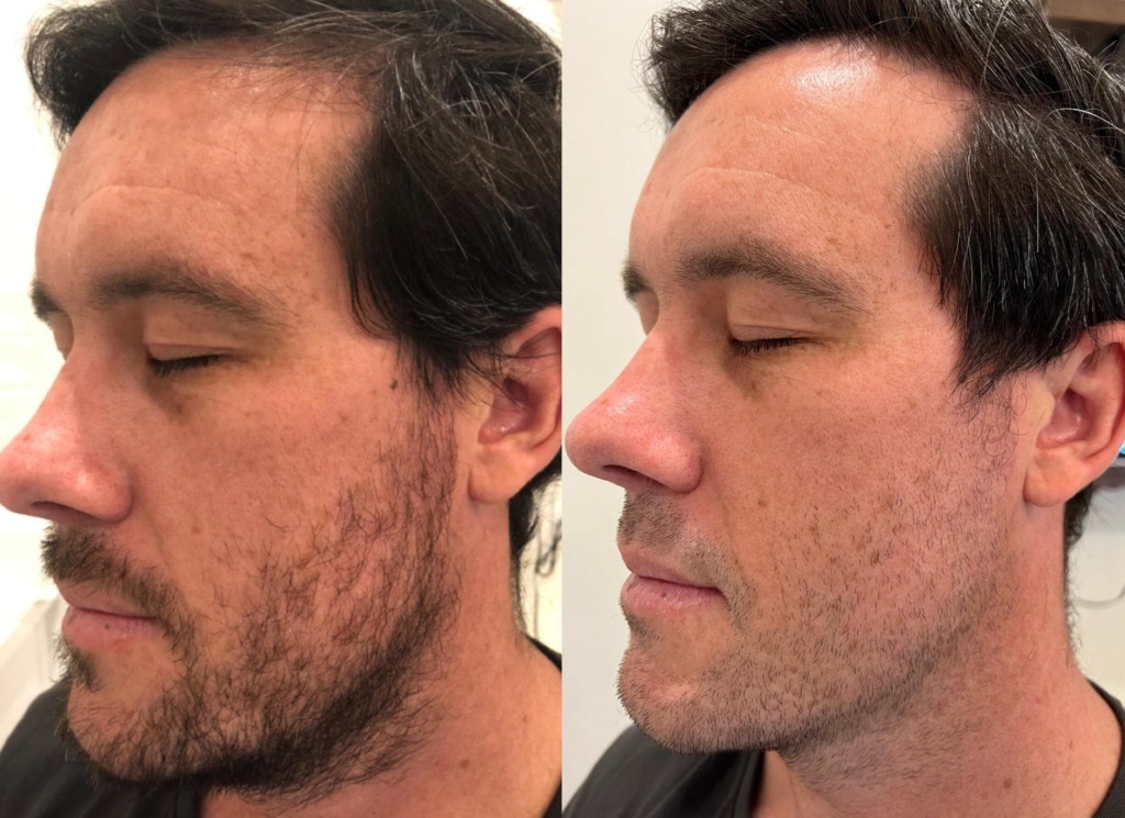 PRP Before and After Results