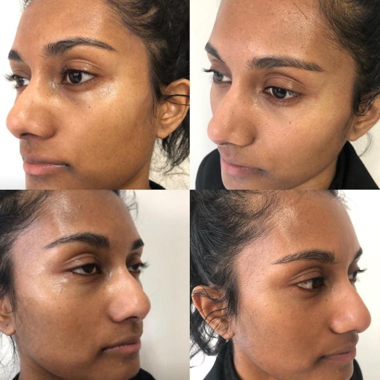 PRP Before and After Results