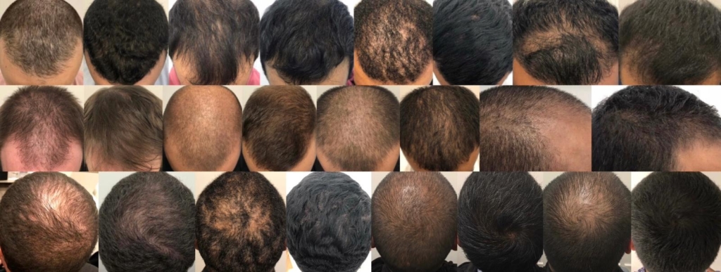 Exosomes for Hair Loss: A Spotlight on Exosomes Brands 1 Exosomes for Hair Loss: A Spotlight on Exosomes Brands 1